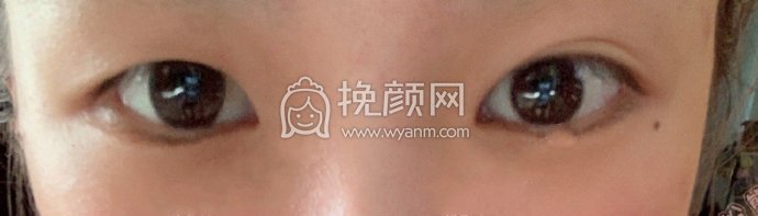 济宁第一人民医院刘郭全切双眼皮手术果|案例