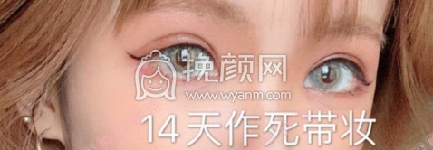 济宁第一人民医院刘郭全切双眼皮手术果|案例