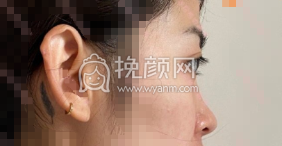 上海整形医生李昕膨体山根肋软骨垫鼻头案例|
