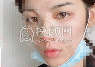 上海整形医生李昕膨体山根肋软骨垫鼻头案例|