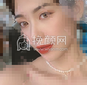 上海整形医生李昕膨体山根肋软骨垫鼻头案例|