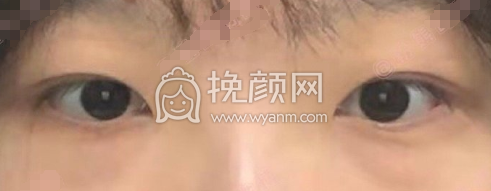 武汉天佑整形田霞医生内切眼袋案例|果|价格