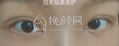 武汉天佑整形田霞医生内切眼袋案例|果|价格
