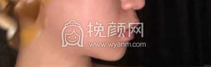 中山大学附属第三医院胡瑛硅胶垫下巴果|案例