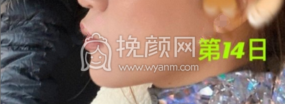 中山大学附属第三医院胡瑛硅胶垫下巴果|案例