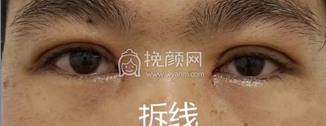 山东济南960医院秦子侃双眼皮内眼角案例|果