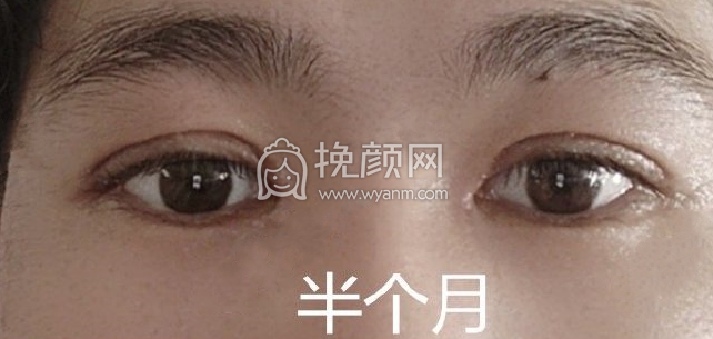 山东济南960医院秦子侃双眼皮内眼角案例|果
