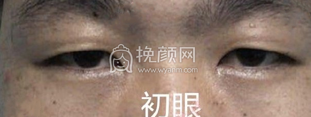 山东济南960医院秦子侃双眼皮内眼角案例|果