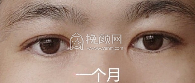 山东济南960医院秦子侃双眼皮内眼角案例|果