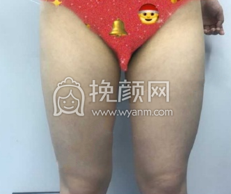 武汉天佑医院田霞大腿环吸+臀沟塑形果|案例