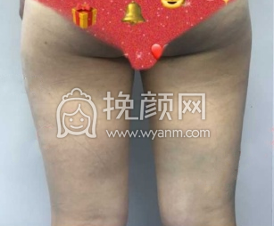 武汉天佑医院田霞大腿环吸+臀沟塑形果|案例