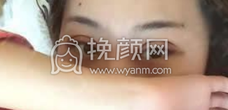 广州华美王栋医生做双眼皮手术怎么样?