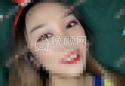 四川大学华西医院成办院银丽双眼皮开眼角果