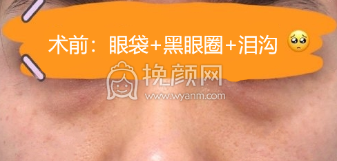 上海维九美容门诊方建蔺眶隔释放祛眼袋案例|