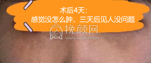 上海维九美容门诊方建蔺眶隔释放祛眼袋案例|