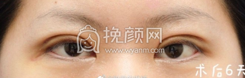 南京第一医院周锦烽改良park法双眼皮案例|果