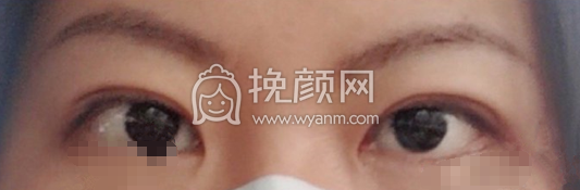 南京第一医院周锦烽改良park法双眼皮案例|果