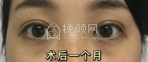 轻美热玛吉抗衰中心银丽院长全切双眼皮案例|