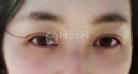 轻美热玛吉抗衰中心银丽院长全切双眼皮案例|