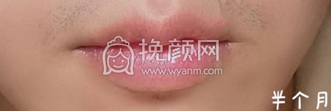 北京八大处吴镝医生厚唇改薄手术案例|果|价格
