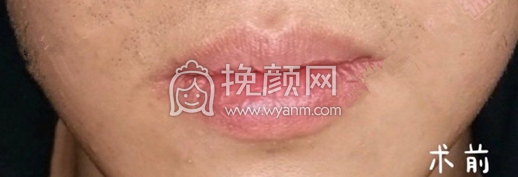 北京八大处吴镝医生厚唇改薄手术案例|果|价格
