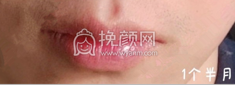 北京八大处吴镝医生厚唇改薄手术案例|果|价格