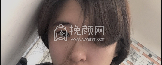潍坊附属医院卢小生医生做的双眼皮案例|果