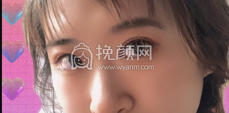 潍坊附属医院卢小生医生做的双眼皮案例|果