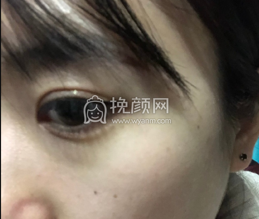 潍坊附属医院卢小生医生做的双眼皮案例|果