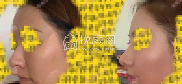 北京八大处焦虎自体脂肪填充山根细纹案例|果