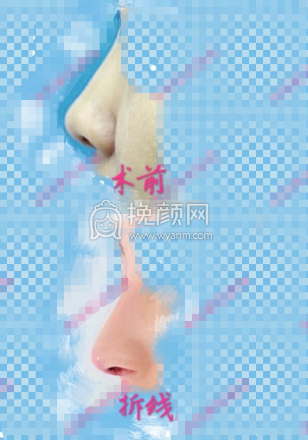 南京范家鑫耳软骨鼻尖+硅胶隆鼻部手术案例|果