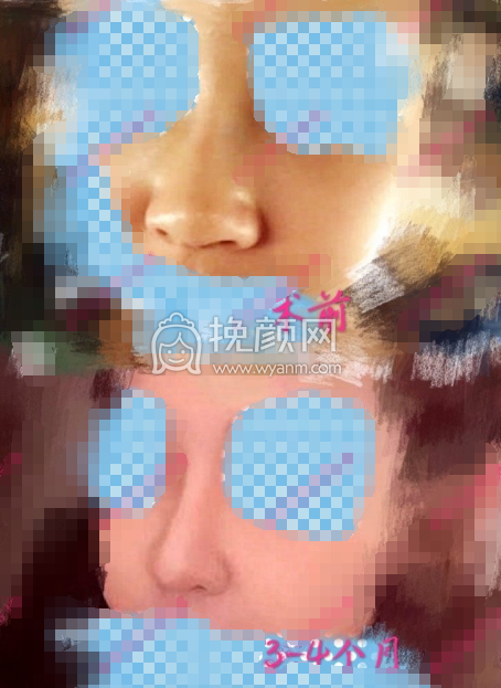 南京范家鑫耳软骨鼻尖+硅胶隆鼻部手术案例|果