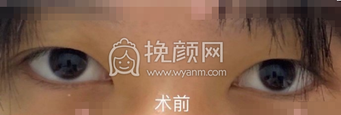 上海九院王俊芳全切双眼皮案例|果|价格