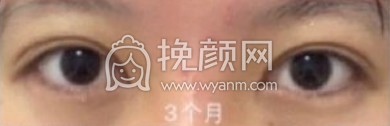 上海九院王俊芳全切双眼皮案例|果|价格