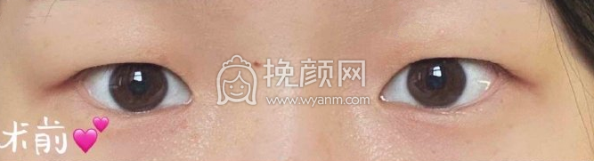 上海九院王文进医生全切双眼皮开眼角案例|果