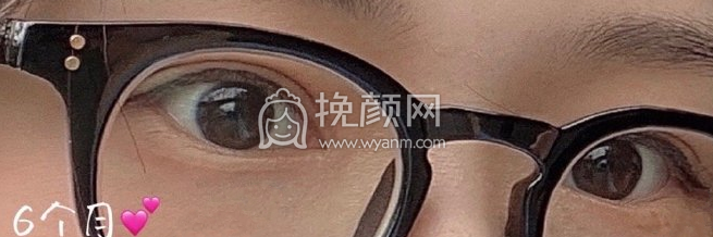 上海九院王文进医生全切双眼皮开眼角案例|果