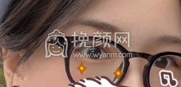 上海九院王文进医生全切双眼皮开眼角案例|果