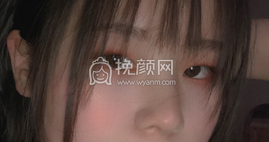 江西南昌医疗美容机构眼部手术双眼皮开眼角案例