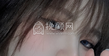 江西南昌医疗美容机构眼部手术双眼皮开眼角案例