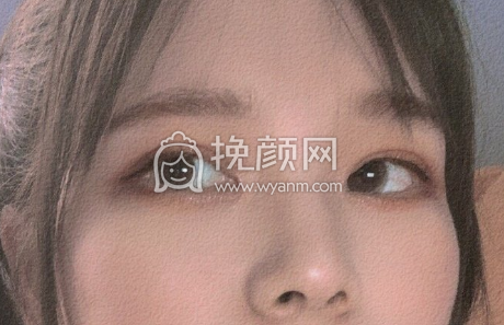 江西南昌医疗美容机构眼部手术双眼皮开眼角案例