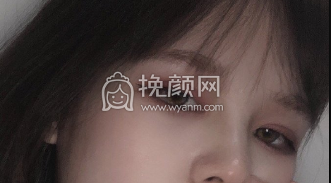 江西南昌医疗美容机构眼部手术双眼皮开眼角案例