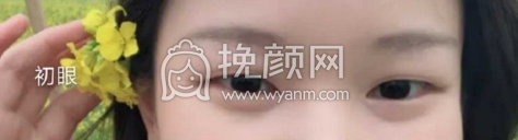 上海九院周一雄医生全切双眼皮案例|果|价格