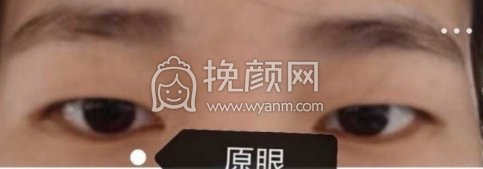 镇江第一人民医院栾文康双眼皮案例|果|价格
