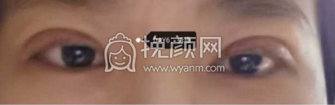 镇江第一人民医院栾文康双眼皮案例|果|价格