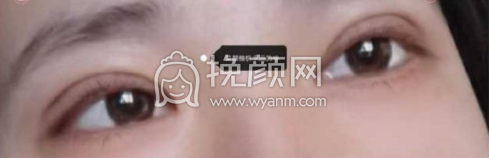 镇江第一人民医院栾文康双眼皮案例|果|价格