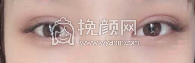 重庆急救医疗中心李伟全切双眼皮案例|果|价格