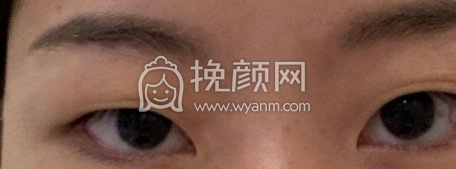 深圳阳光春天杨淑云全切双眼皮开内眼角案例|