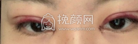 深圳阳光春天杨淑云全切双眼皮开内眼角案例|