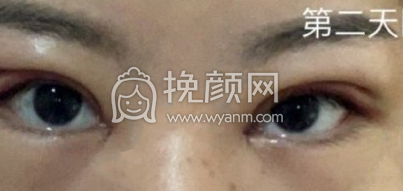深圳阳光春天杨淑云全切双眼皮开内眼角案例|