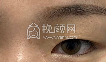 合肥蝶之星整形李树平全切双眼皮案例|果|价格